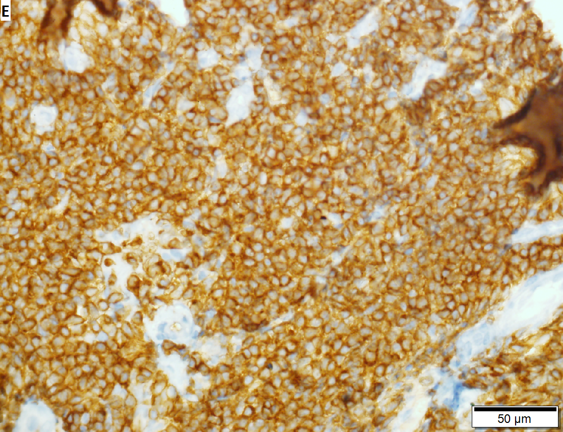 Malignant B cell lymphoma, NOS, in a 63 year old man’s liver