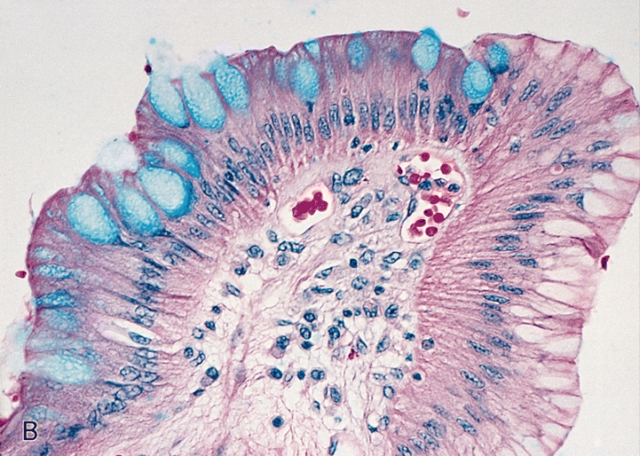 File:Barrett's mucosa, higher magnification, Alcian blue stain.jpg