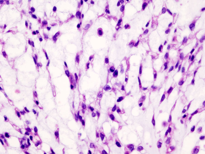 File:Chondrosarcoma (3).jpg