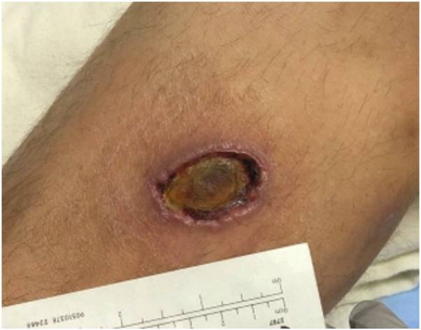 File:Clinical photo of necrotic ulceration.png