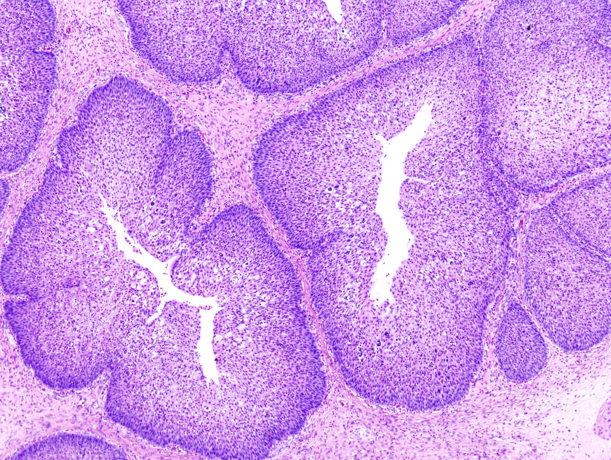 Papilloma a cellule squamose ugola - Papilloma sul labbro