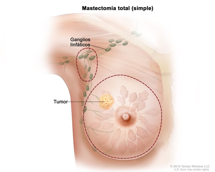 Resultado de imagen para CANCER DE MAMA