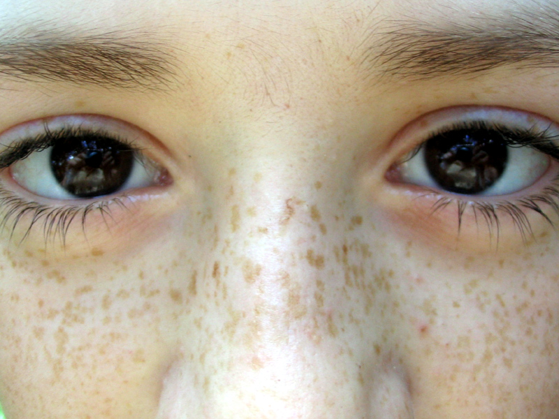 Freckle Wikipedia