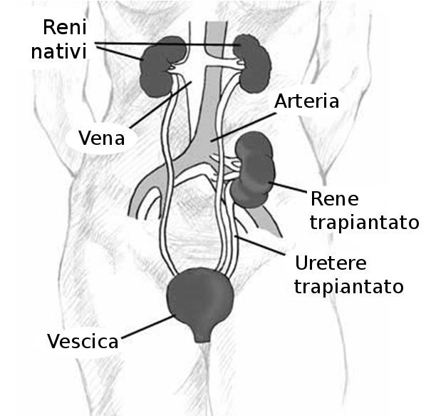 Trapianto, rene