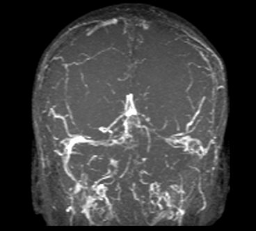 File:SVT, TOF angiography, coronal MIP reconstruction.jpg