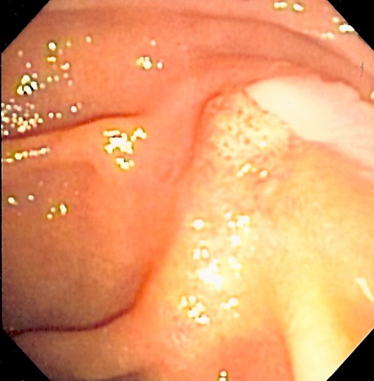 File:Cholangitis.jpg