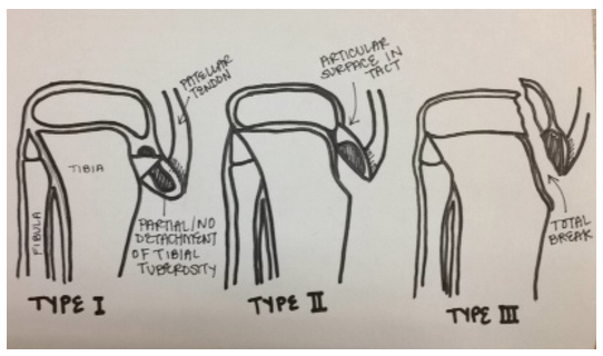 File:Three types of avulsion fractures.png