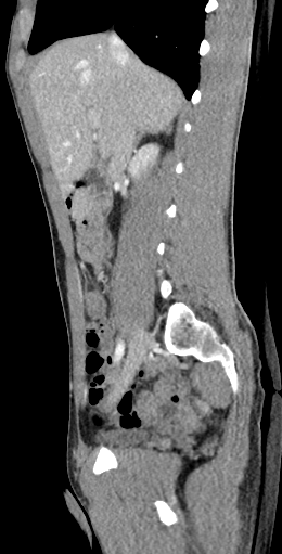 CT of a normal abdomen and pelvis, sagittal plane 70.png