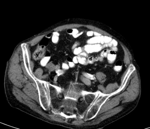 File:Hufeisenniere 07 - CT - axial - 003.jpg