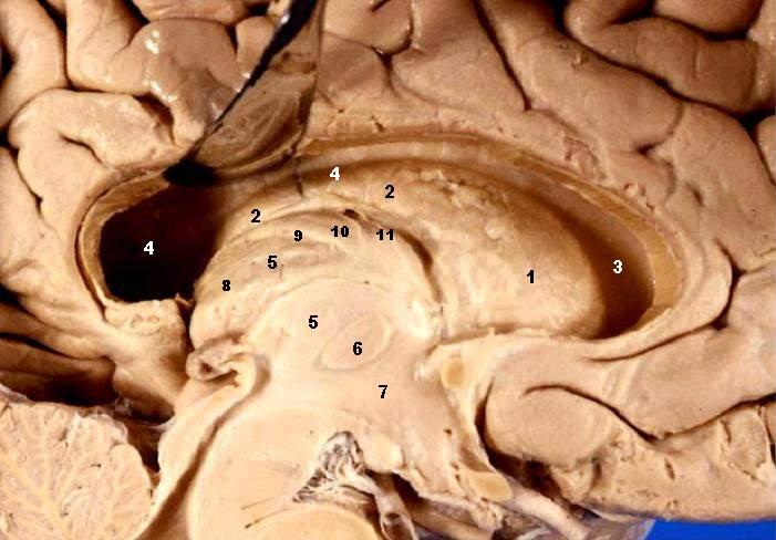 File:Human brain left dissected midsagittal view description 2.JPG