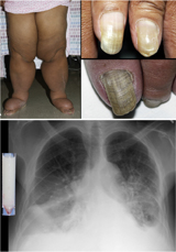 Yellow nail syndrome Human disease