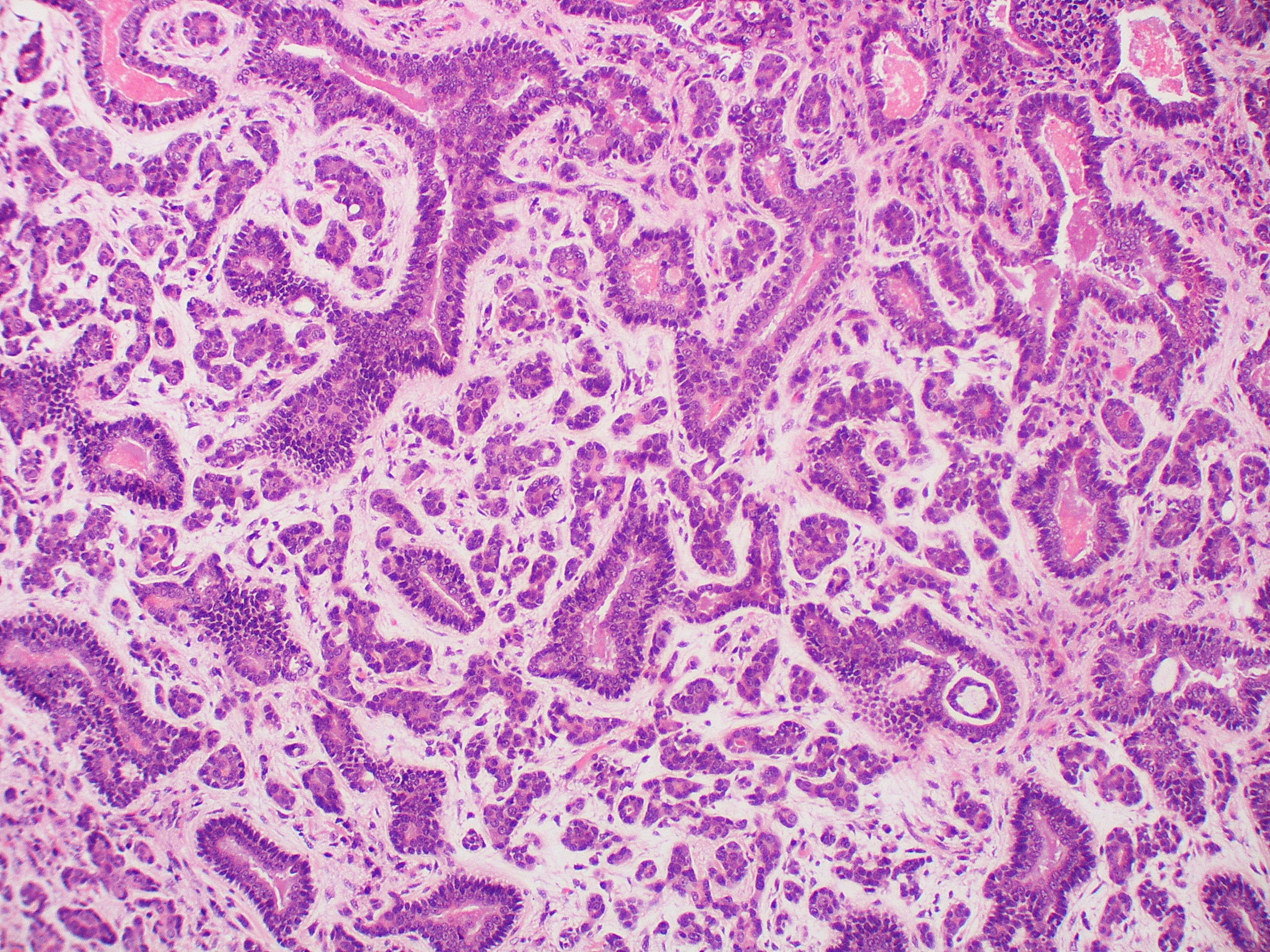 adenoid cystic carcinoma)