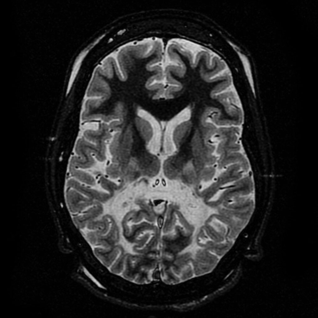 Adrenoleukodystrophy Wikipedia