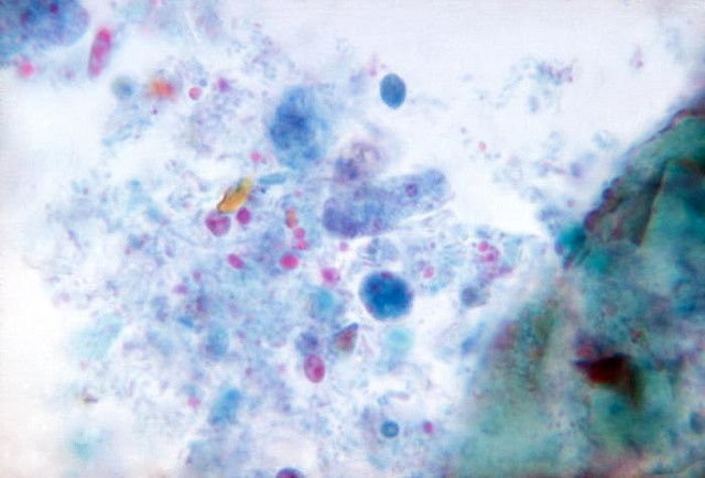 dientamoeba fragilis trophozoite