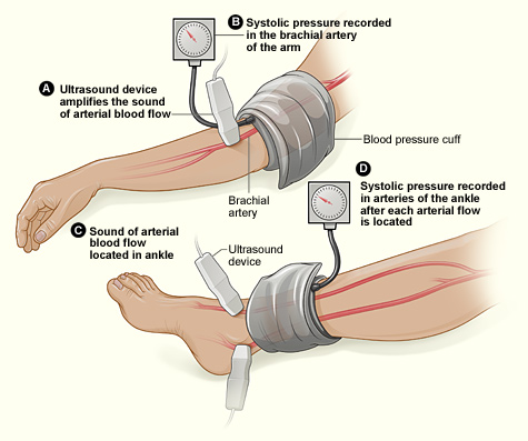 how to test blood pressure in legs