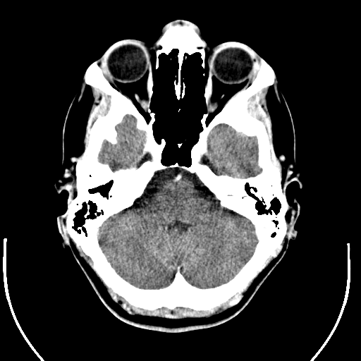 File:Computed tomography of human brain (6).png