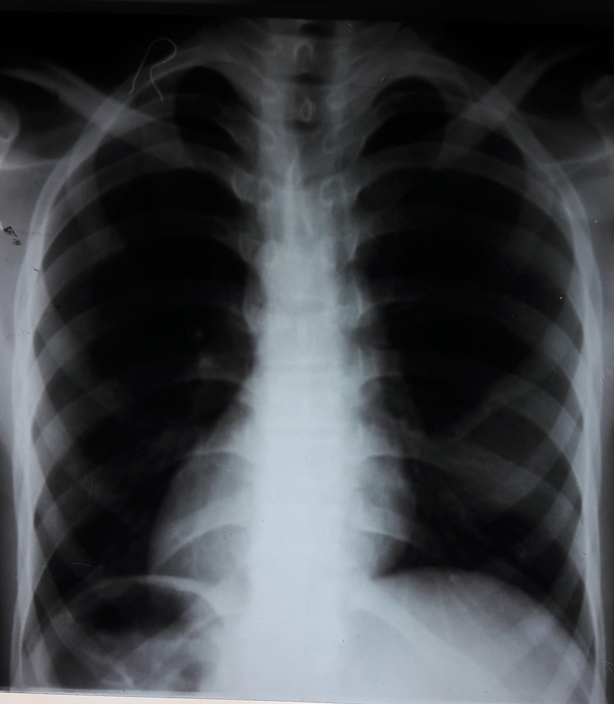 File Dextrocardia On Chest Radiograph Jpg Wikimedia Commons