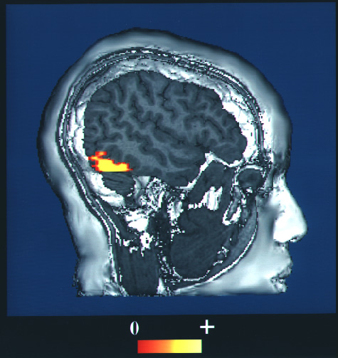Een fMRI-scan van iemand die gezichten bekijkt, waarbij het fusiform aangezichtshersengebied geactiveerd wordt.