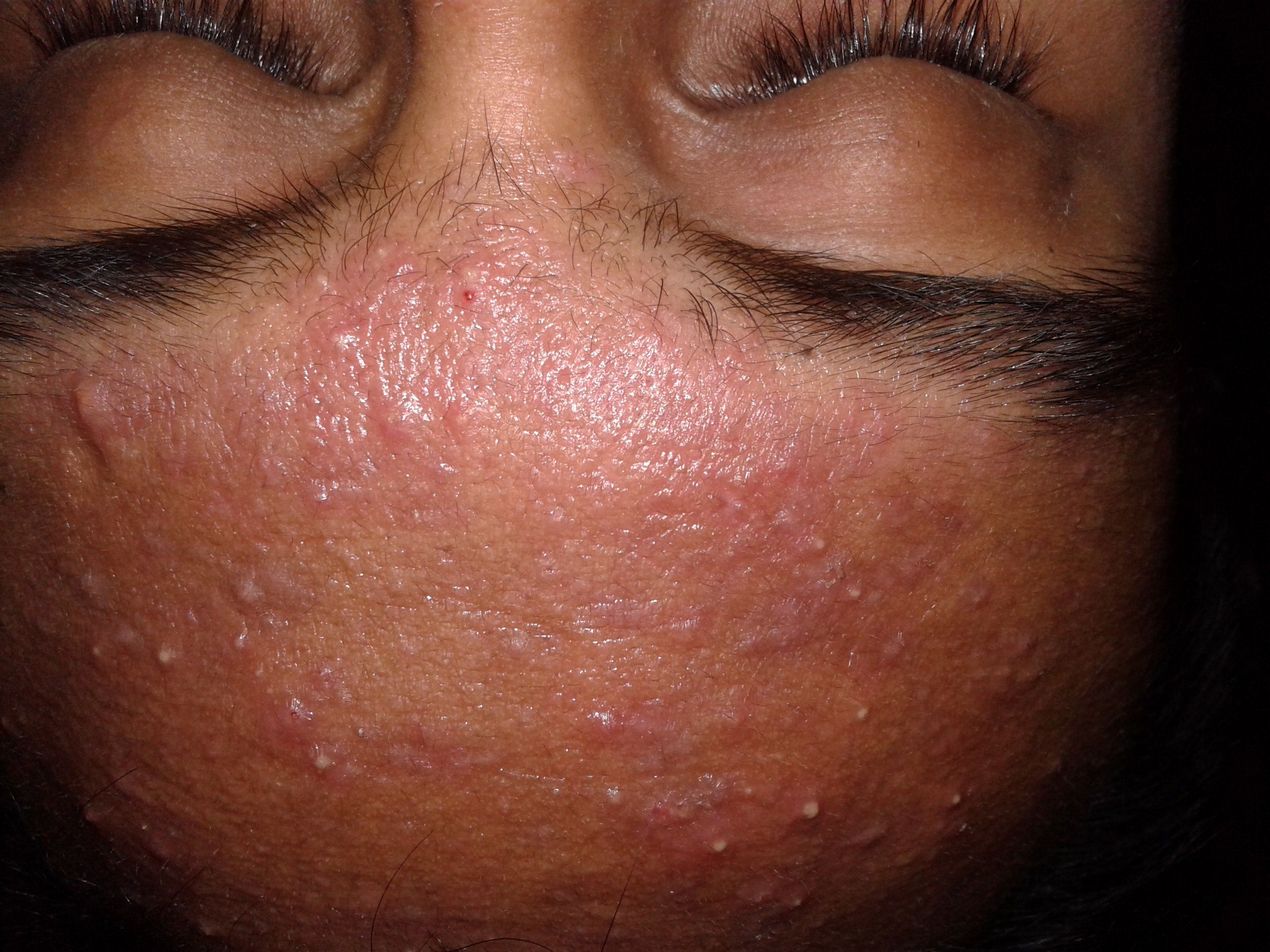 S.O.S Acnee: cauzele aparitiei acneei