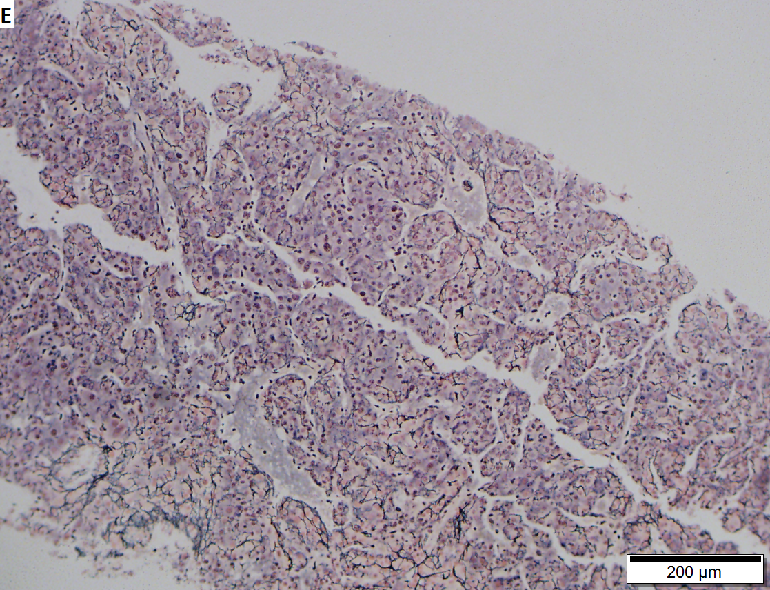 Hepatocellular carcinoma arising in cirrhosis