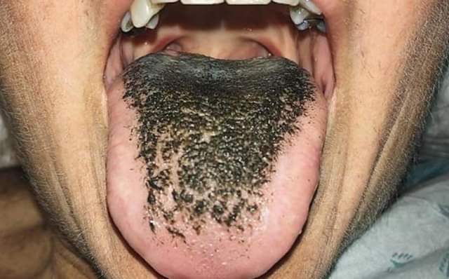 Image result for hairy tongue - How To Remove Plaque From Tongue