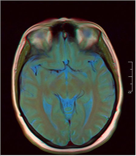 File:Brain MRI 0037 11.jpg