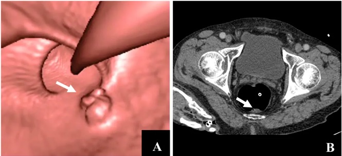 colonoscopy wiki