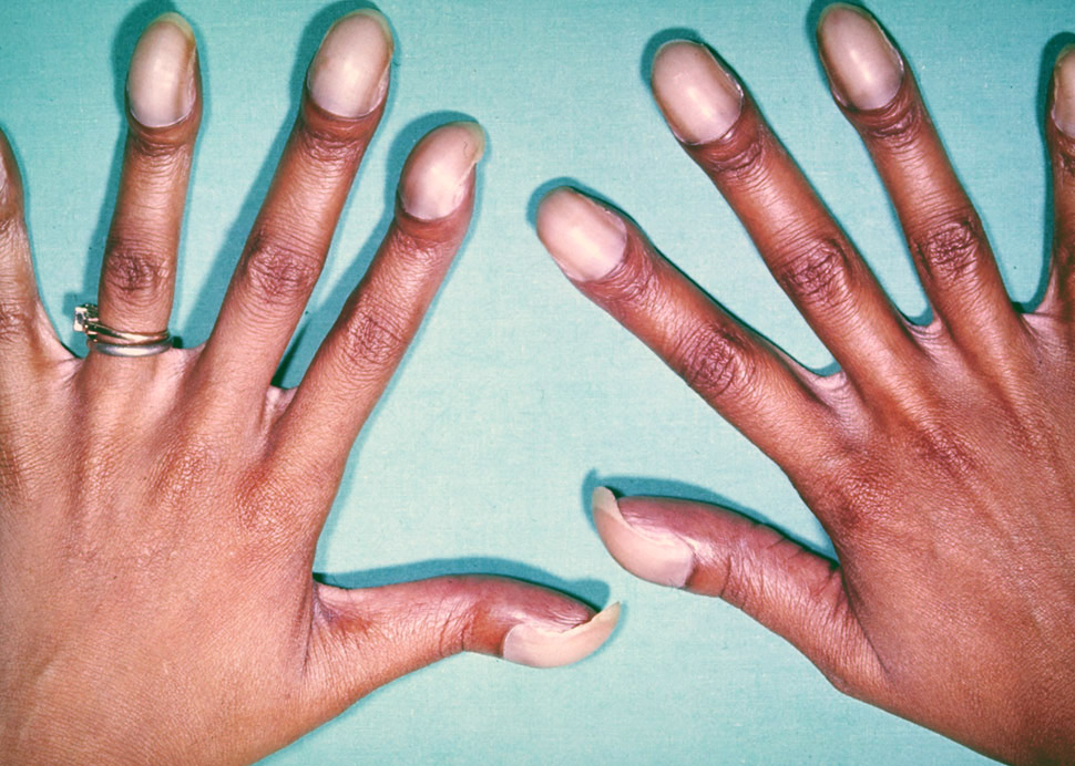 Nail Changes Alert Woman to Lung Cancer | Moffitt