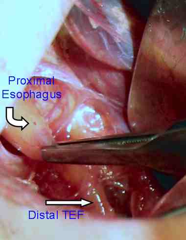 File:Esophageal Atresia for Website.jpg