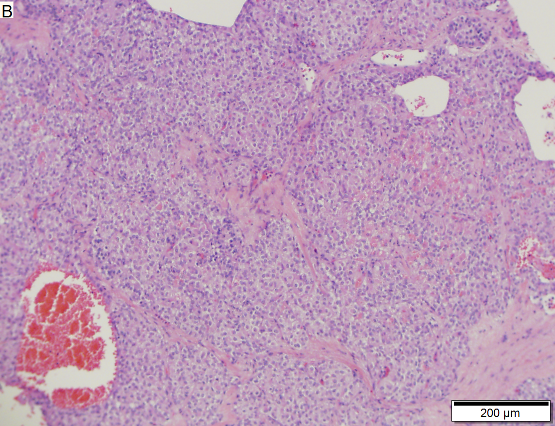 Solid-pseudopapillary neoplasm of pancreas