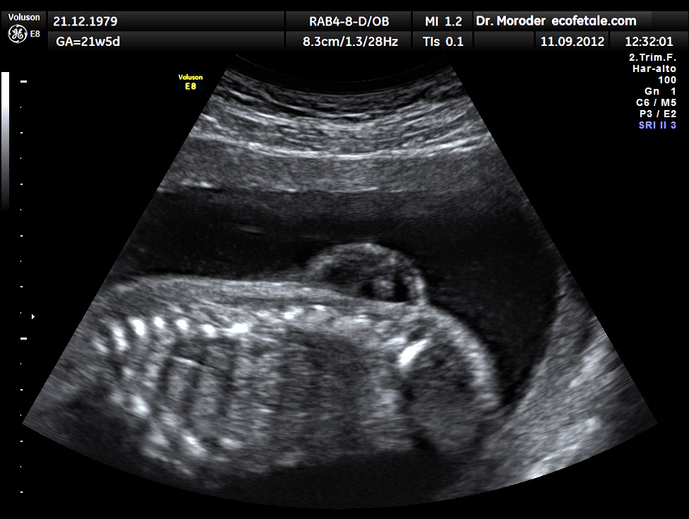 spina bifida ultrasound 12 weeks