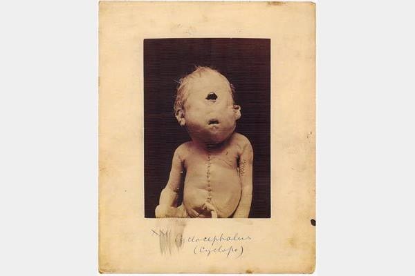 File:Cyclops-genetic condition which causes a foetus to have only single eye in the centre of head 2014-02-15 00-57.jpg