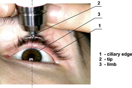 File:Diaton tonometer IOP through Eyelid.png