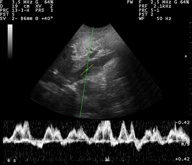 pulsed wave doppler