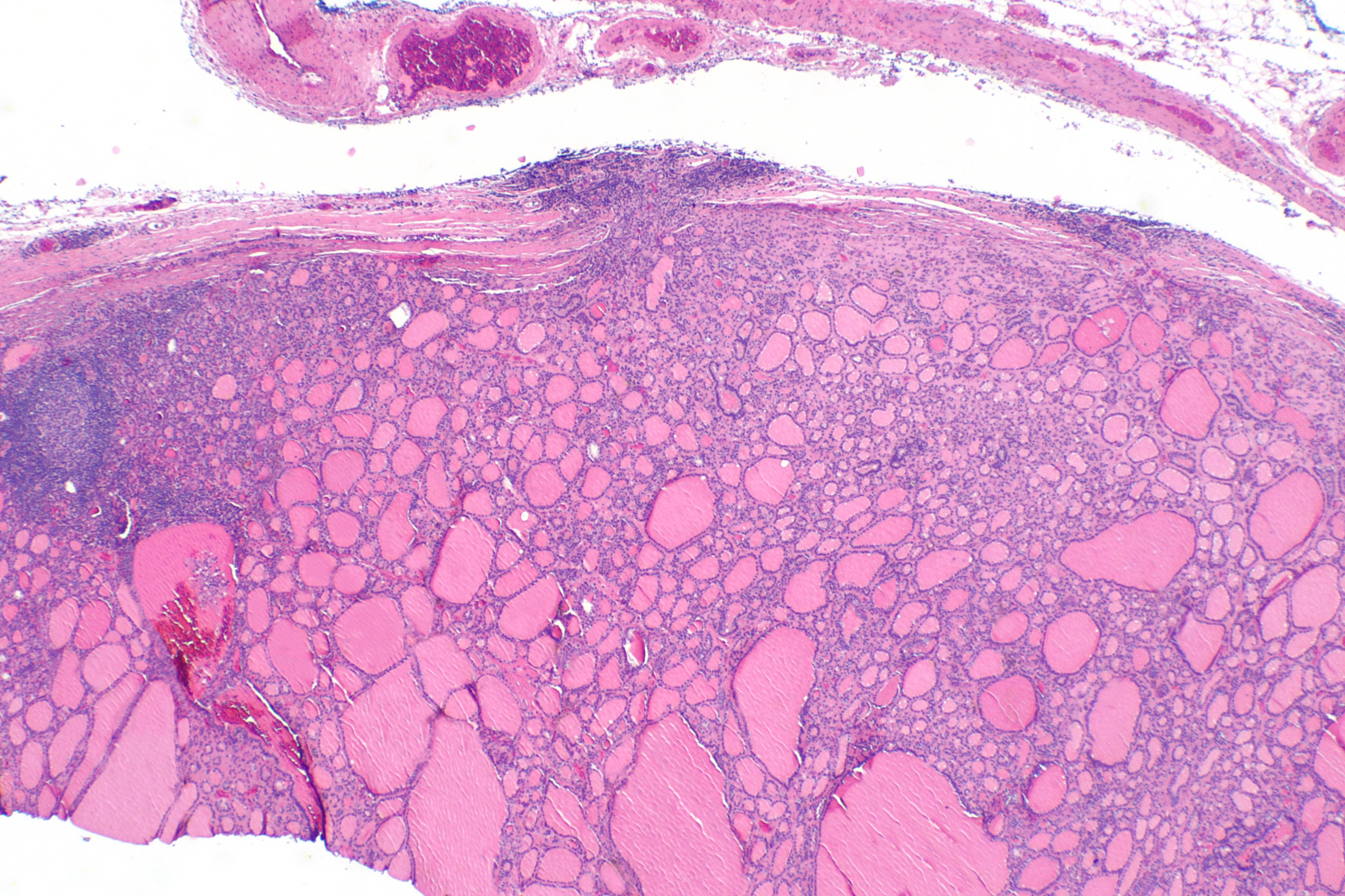 Щитовидная железа фолликулярные. Medullary Thyroid carcinoma Immunohistochemistry.