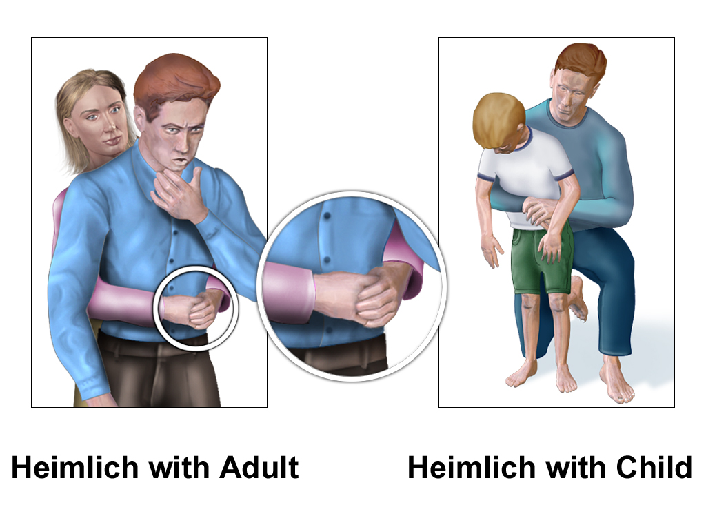 Etouffement bébé, enfant : gestes et manoeuvres de secours