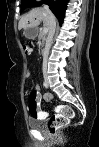 File:Bouveret-Syndrom case 001 - CT - sagittal - 016.jpg