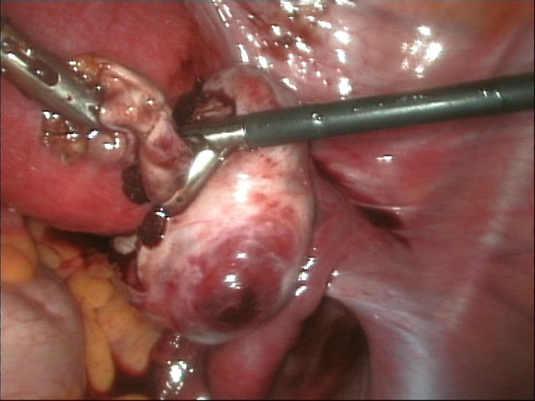 File:Cyst resection.jpg