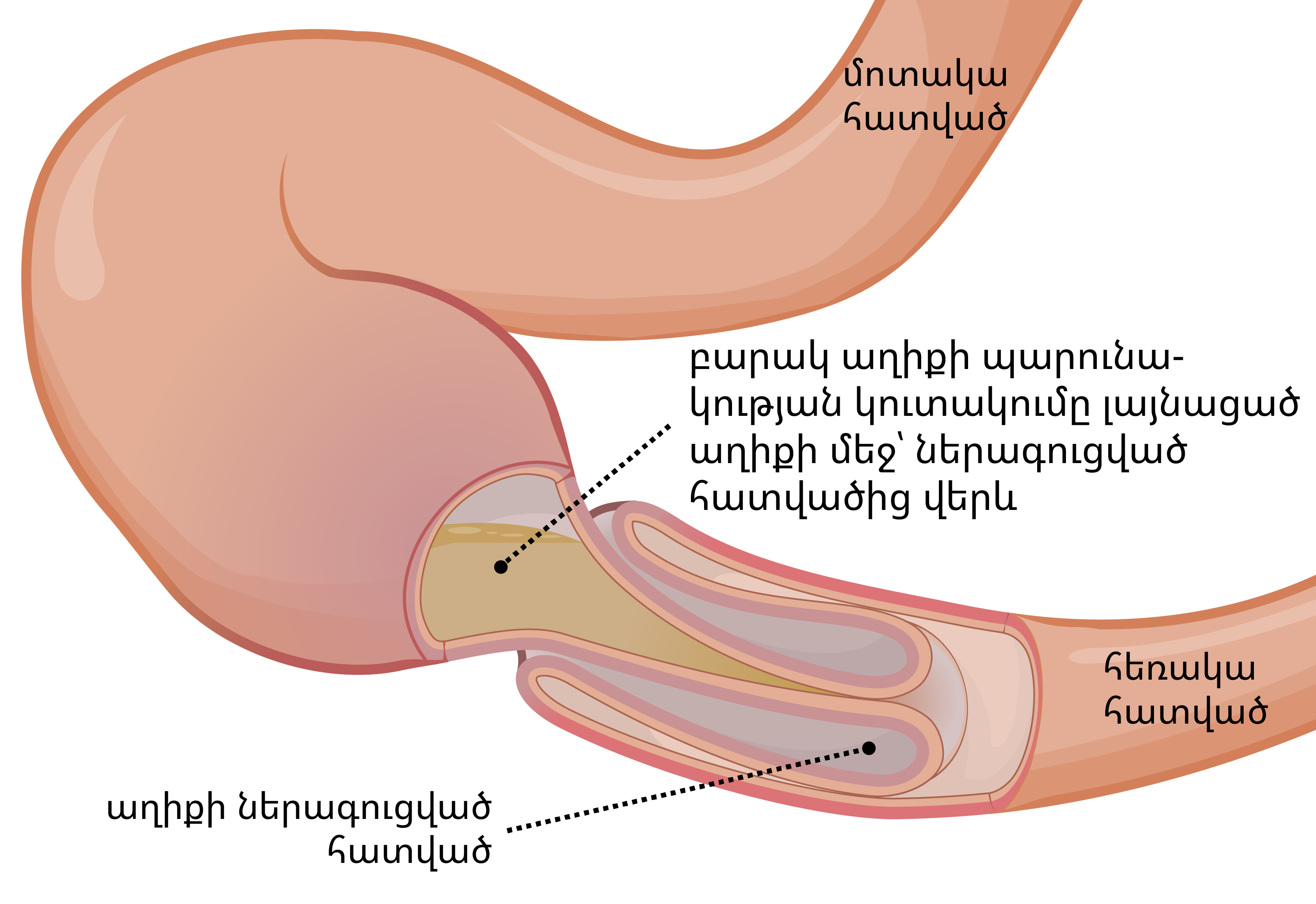 Инвагинация тонкого кишечника