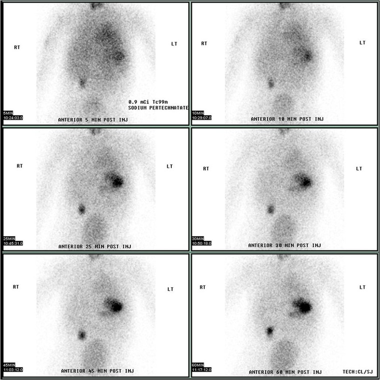 梅克爾憩室核醫檢查。來源：https://commons.wikimedia.org/wiki/File:Meckel's_Diverticulum_by_Technetium-99m_Pertechnetate_Scan.jpg