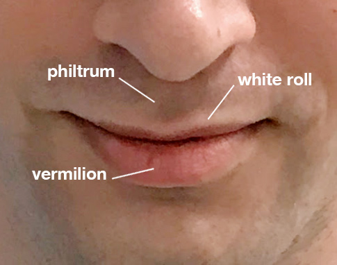 what causes white line on lips