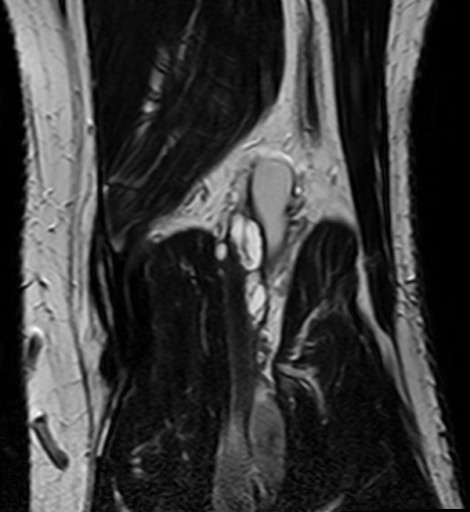 File:Zystische Adventitiadegeneration - MRT - T2 coronar - 011.jpg