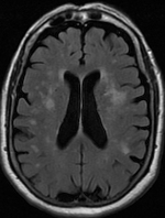 <span class="mw-page-title-main">Leukoaraiosis</span> Type of white matter abnormality near the lateral ventricles