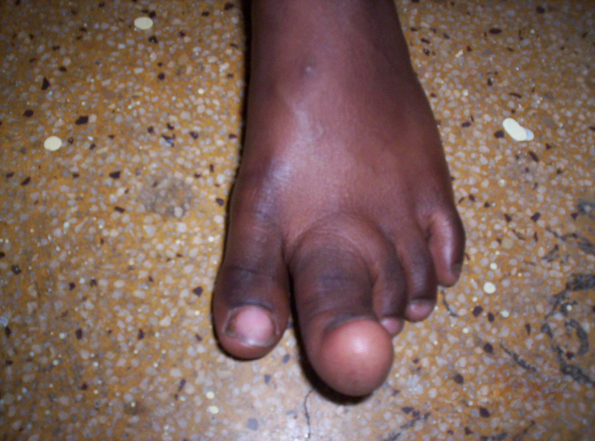 abnormal toe growth