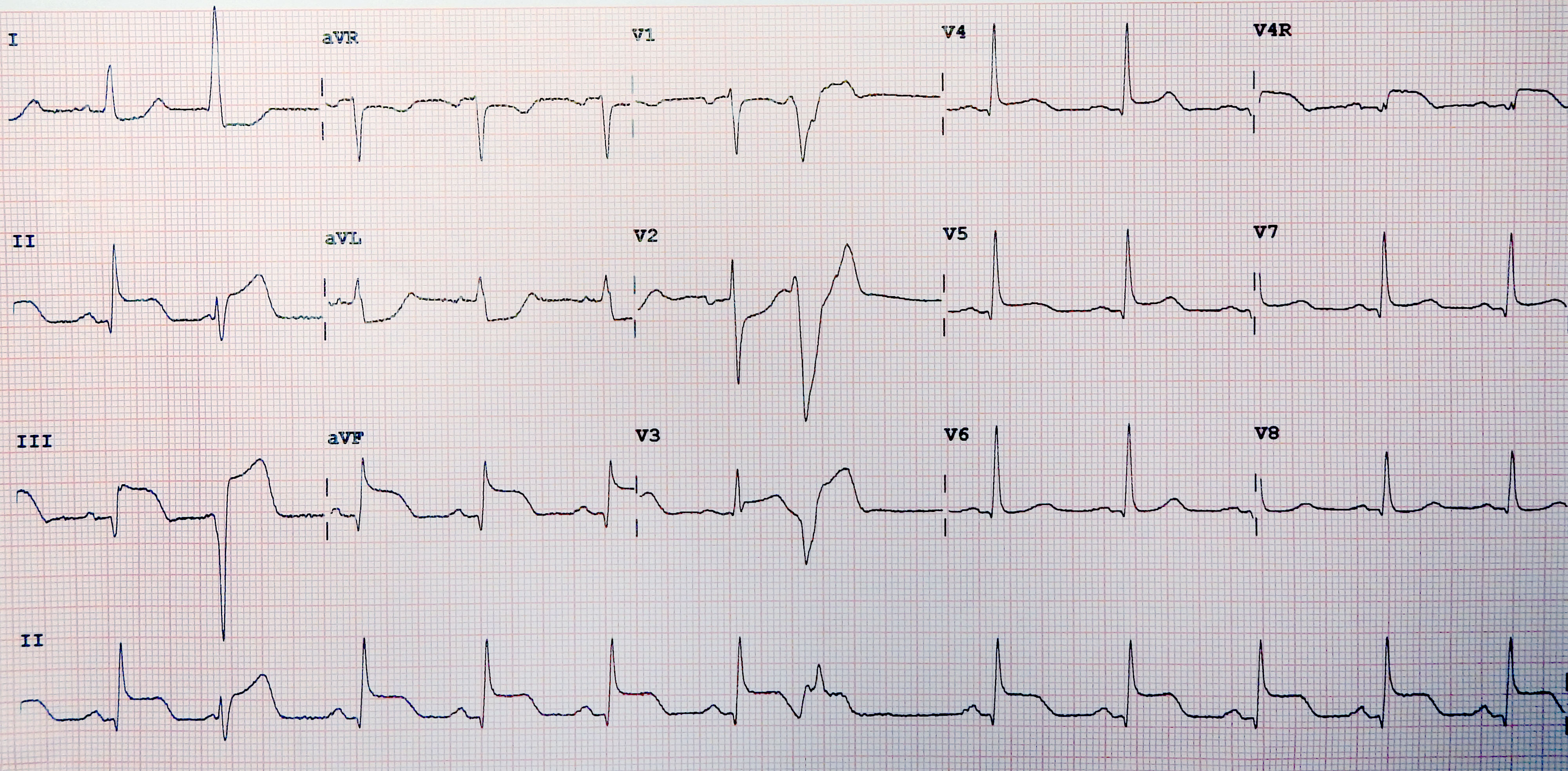 st segment elevation myocardial infarction