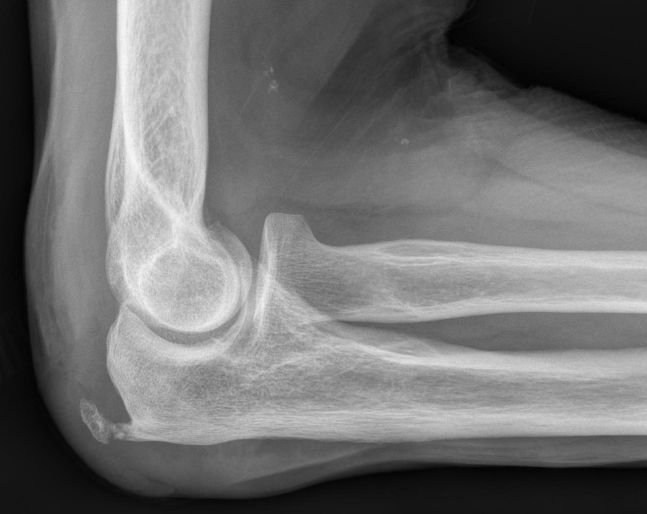 olecranon bursitis mri