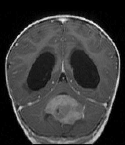 File:Medulloblastom - MRT - coronar mit KM - 025.jpg