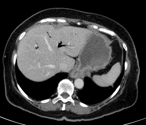 File:Bouveret-Syndrom case 001 - CT - axial - 007.jpg