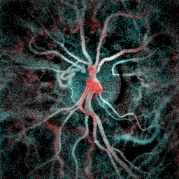 File:Collateral vein in central retinal vein occlusion.gif