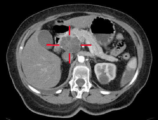 File:MBq cystic-carcinoma-pancreas.jpg